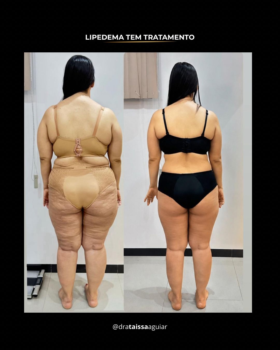 Resultado real 2 - Tratamento de lipedema com Dra. Taissa Aguiar