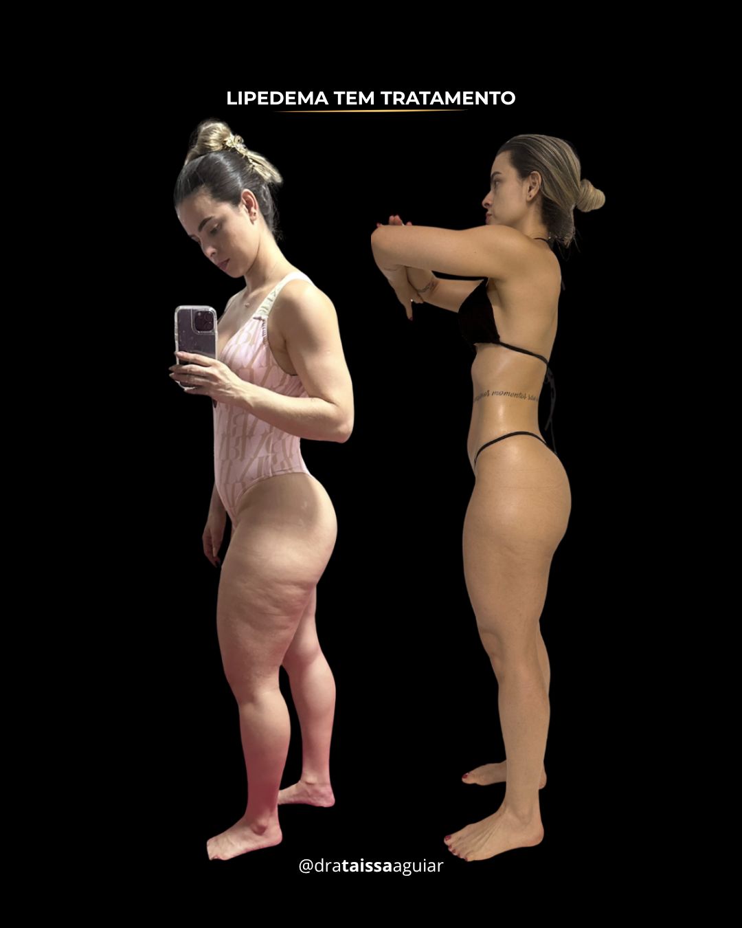 Resultado real 1 - Tratamento de lipedema com Dra. Taissa Aguiar
